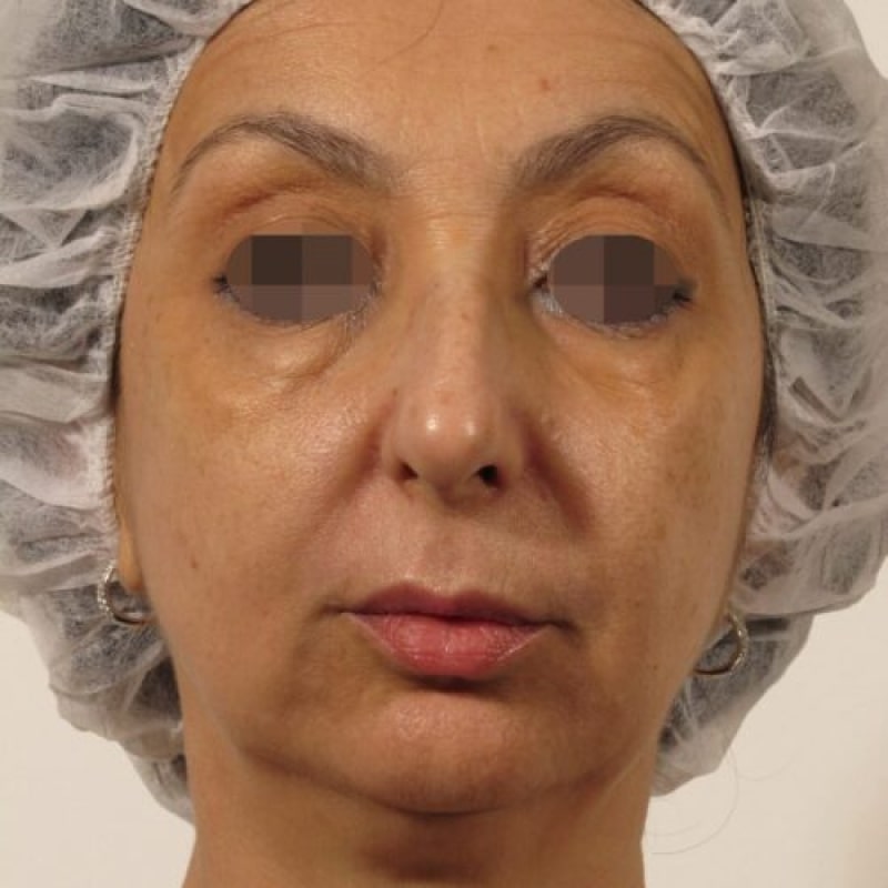 Before image
